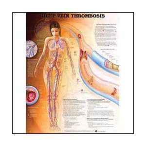 Deep Vein Thrombosis Anatomical Chart Unmounted  