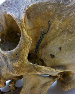 Antique REAL Human Skull   Genuine Medical Skeleton   RARE Star Shaped 
